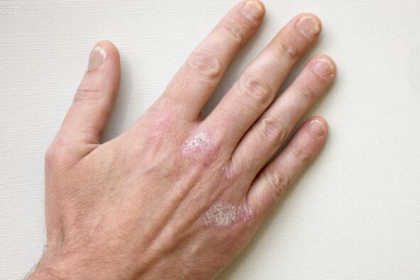 psoriasis op de handen