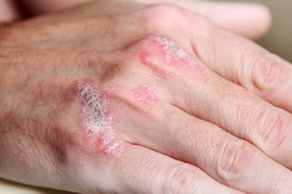 psoriasis symptomen op de handen