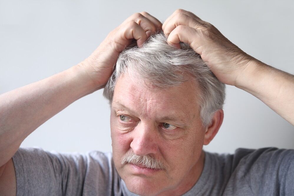 psoriasis symptomen op het hoofd