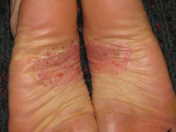 psoriasis op de voeten