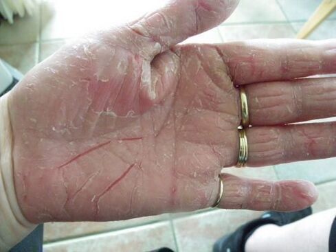 psoriasis in de palm van je hand