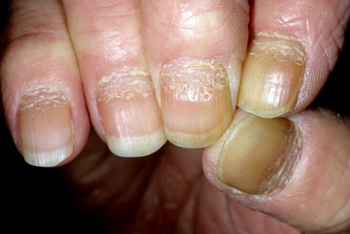psoriasis op de nagels