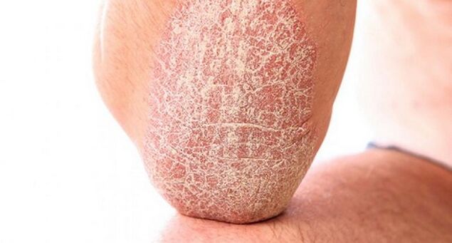 psoriasis vulgaris op de huid