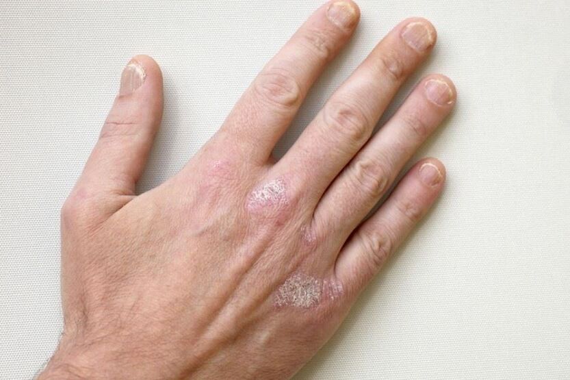 Een verplicht symptoom van psoriasis zijn plaques met schubben op de huid