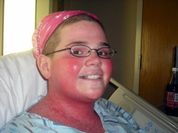 roodheid van de huid als gevolg van psoriasis in het gezicht