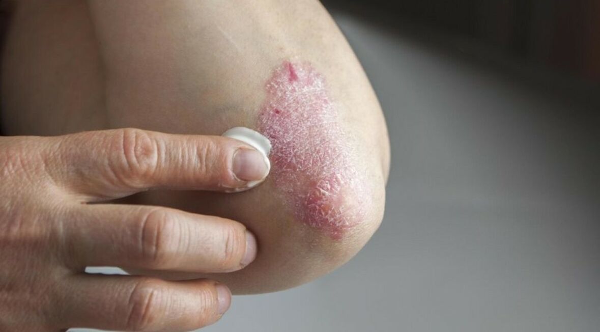Psoriasis die de huid aantast, waarvan de behandeling het gebruik van zalven omvat