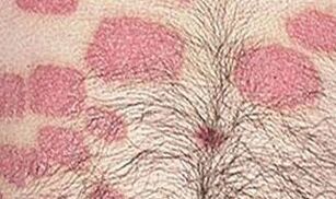 Meerdere roze formaties op de buik