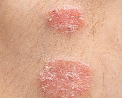 Uiterlijk van psoriatische plaques