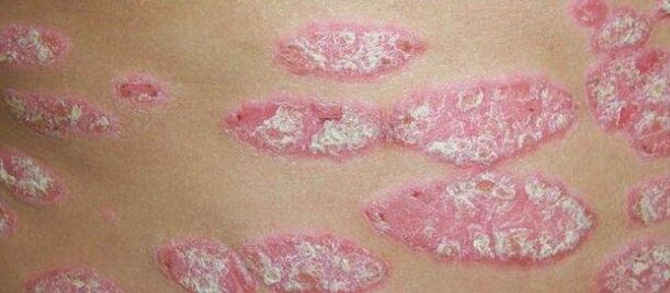De progressieve fase van psoriasis