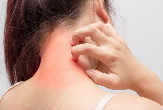 Jeuk is een van de oorzaken van psoriasis