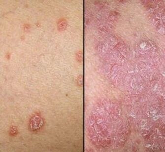 Psoriatic plaques
