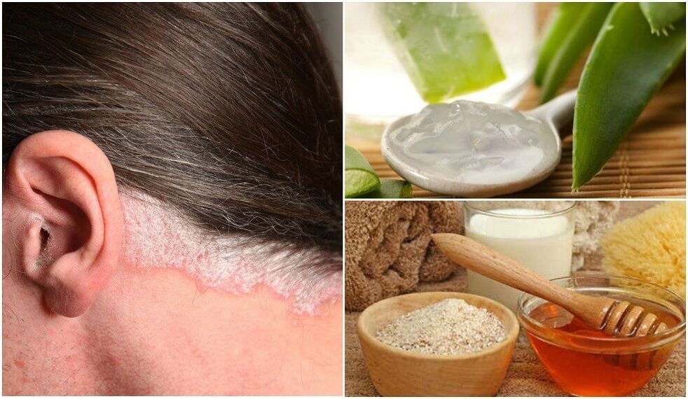 Behandeling van psoriasis met folk remedies