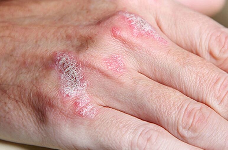 Ladomary-zelfstandige psoriasis