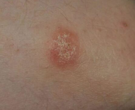 Psoriasis plek