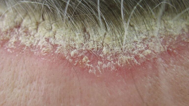 Psoriasis van de hoofdhuid