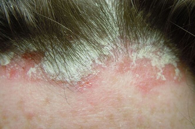 Psoriasis vangt het hele harige deel van het hoofd