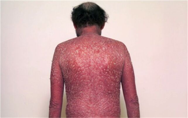 De derde fase van psoriasis