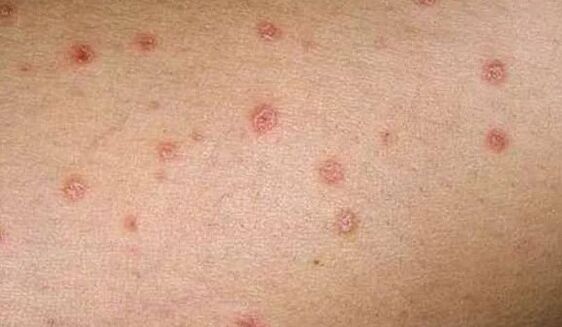 De eerste fase van psoriasis