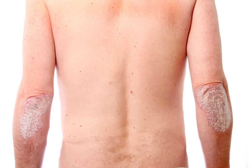 De tweede fase van psoriasis