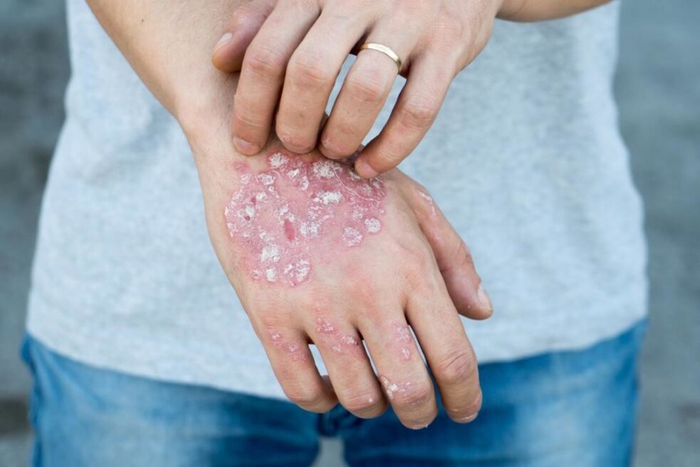 Psoriasis is