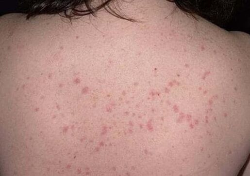 De eerste fase van psoriasis
