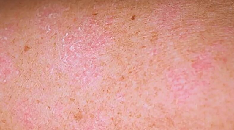 De regressieve fase van psoriasis