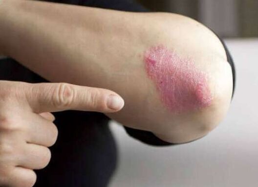 Het stationaire podium van psoriasis
