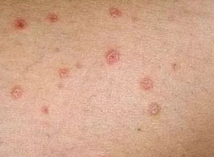 Psoriasis van de eerste fase