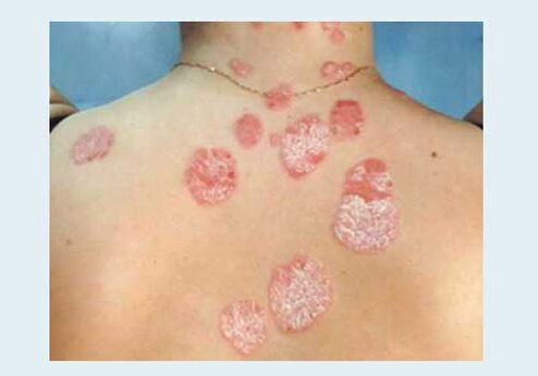 Gewone psoriasis