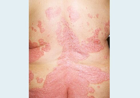Psoriasis van de rug
