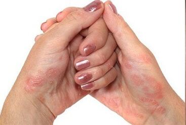 Psoriasis in de handen