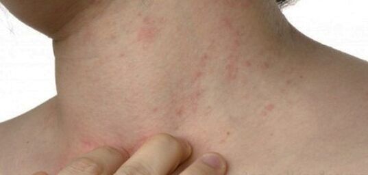 Psoriasis in de nek