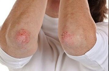 Psoriasis op de ellebogen
