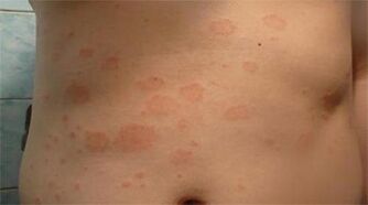 Psoriasis op de maag