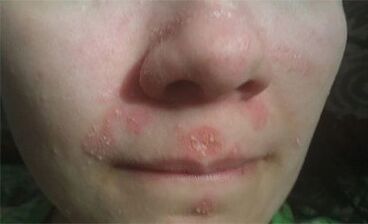 Psoriasis op het gezicht