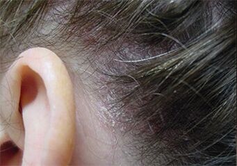 Psoriasis op het hoofd