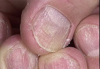 Psoriasis van nagels