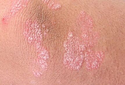 psoriasis
