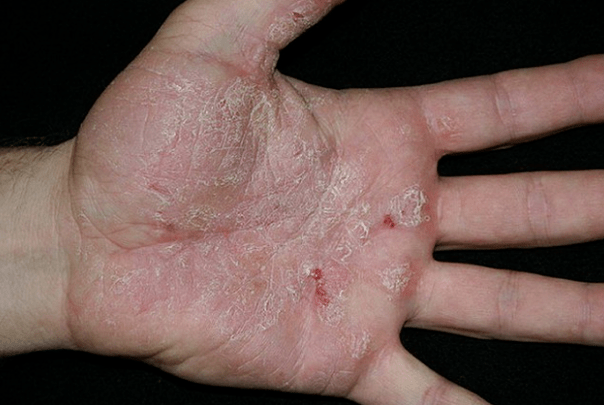 Psoriasis in de handen