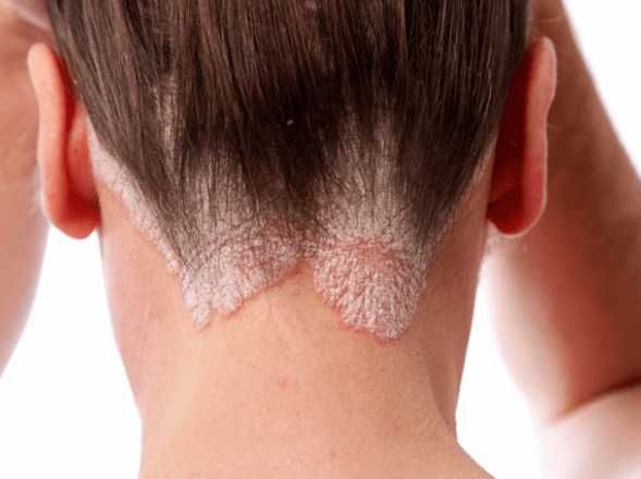 Psoriasis op het hoofd