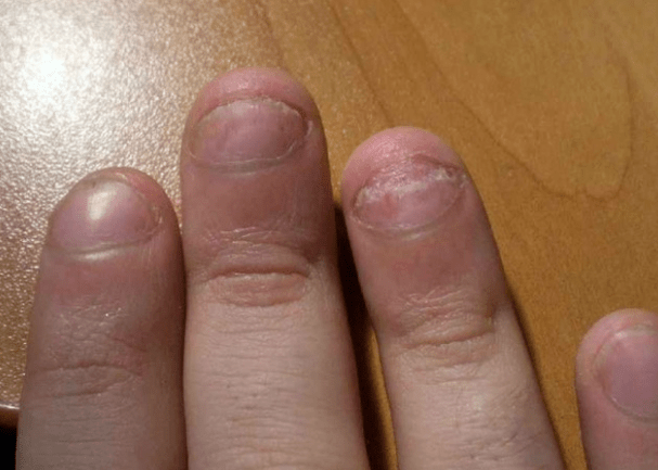 Psoriasis van nagels