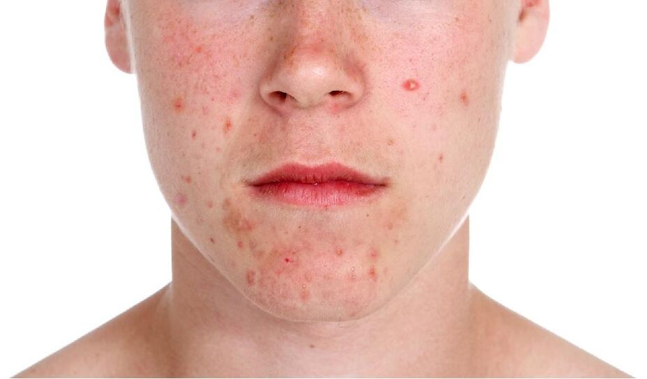 Psoriasis op het gezicht