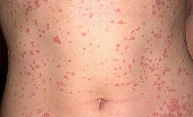 Psoriasis op het lichaam