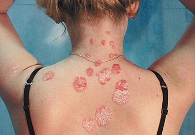 Psoriasis op de achterkant