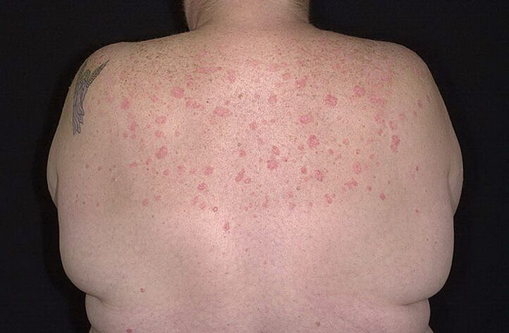 Psoriasis op de schouders