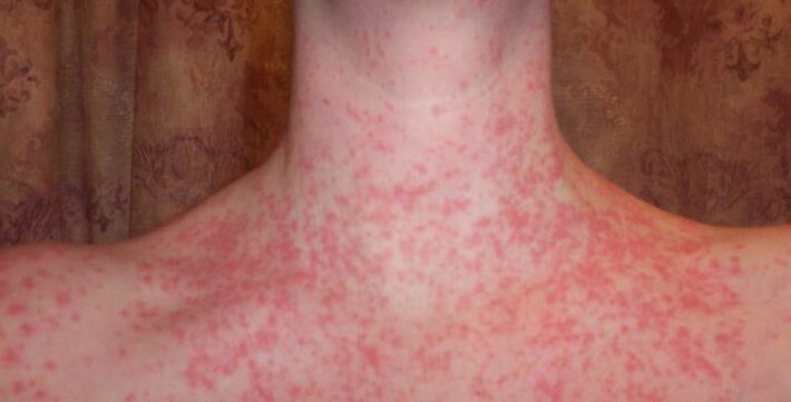 Psoriasis op het lichaam