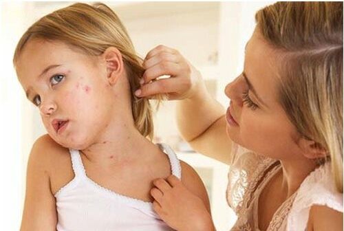 Foto van de eerste fase van psoriasis