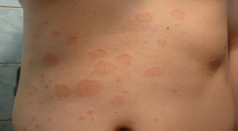 Psoriasis van de eerste fase
