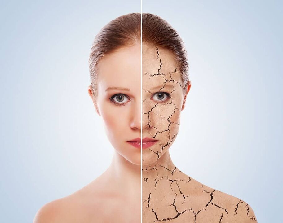 Gezonde huid en door psoriasis aangetaste huid