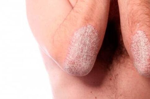 Psoriasis op de ellebogen